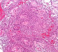 Ependymoma low intermed mag.jpg