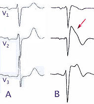 Brugada EKG Schema.jpg