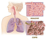 Copd versus healthy lung.jpg