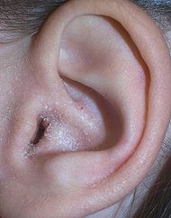 Eczema ear2.jpg