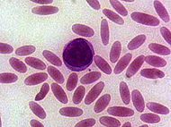 Elliptocytosis.jpg