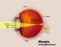 Myopia.gif