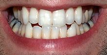 Teeth by David Shankbone.jpg