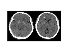 Brain computer tomography cuts of the patient with 22q11.2 syndrome, demonstrating basal ganglia and periventricular calcification.jpg