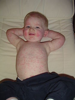  A 16 month old child with Fifth Disease (aka Slapped face, Parvovirus B19).