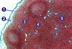 Préparation histologique d'un ganglion lymphatique montrant (1) capsule, (2) sinus sous capsulaire (3) centre germinal (4) nodule lymphoide (5) trabeculae.