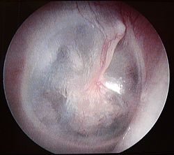 La membrane tympanique droite vue lors de l'otoscopie.
