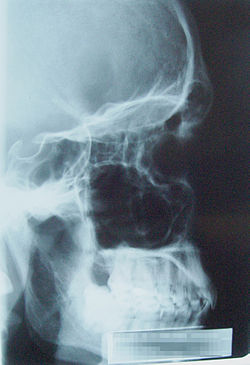 Projection latérale des sinus paranasaux (qui apparaissent en noir sur une radiographie car remplis d'air)