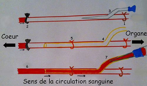 Schéma d'une canulation artérielle