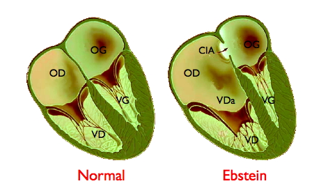 Malposition de la valve tricuspide dans l'anomalie d'Ebstein