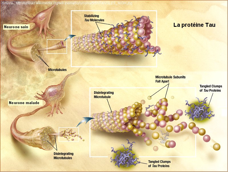 Protéine Tau dans un neurone sain et dans un neurone malade